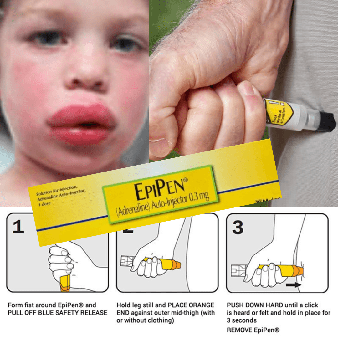 EpiPen 0.3mg Auto-Injector A Critical Tool for Anaphylaxis